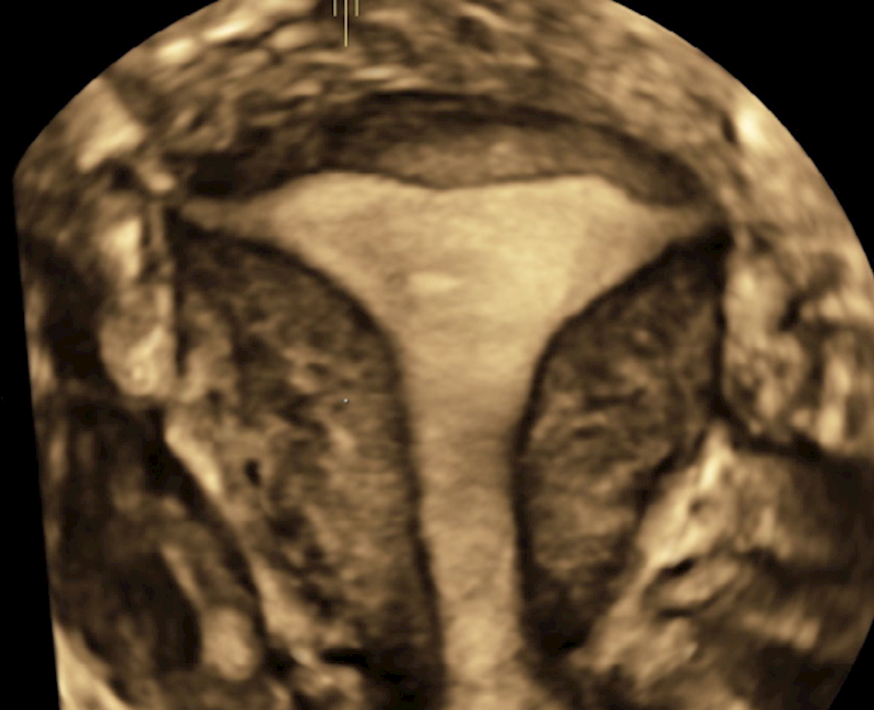 Three-dimensional gynaecological ultrasound, part one: How, when and why?